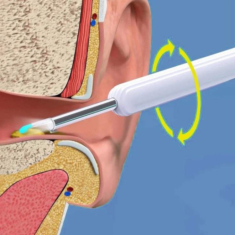 EarScope Pro Wax Removal Kit with camera and LED lights, showcasing its sleek design and effectiveness for ear cleaning.